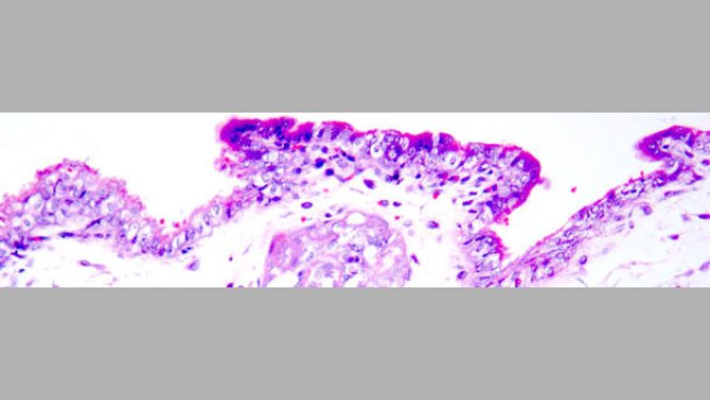 Coagulation necrosis of trophoblasts. Haematoxylin and eosin stain.