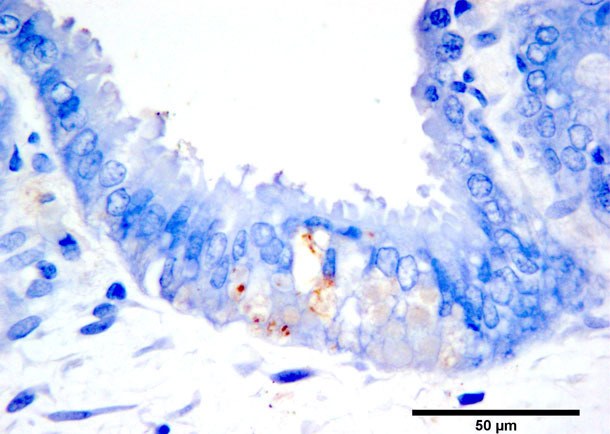 Immunohistochemical brown staining of PCV2b antigen in necrotic trophoblasts. Diaminobenzidine chromogen and haematoxylin counterstain.