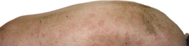 Urticarial form of swine erysipelas