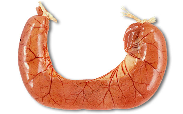 The autopsy of ETEC diarrhoea cases usually shows dilated, congested thin small intestine loops filled with the watery yellow diarrhoea