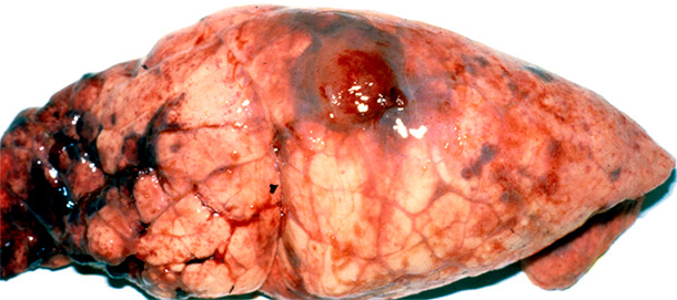 Chonic App lesion in the diaphragmatic lobe with pleuritc tags