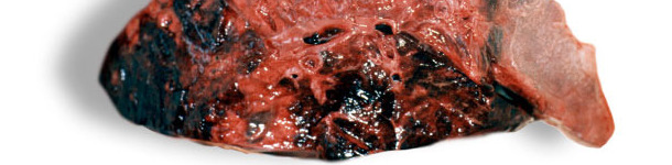 Showing deep haemorrhagic lesions in lung parenchyma