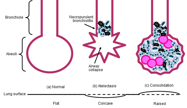 Bronchiolae