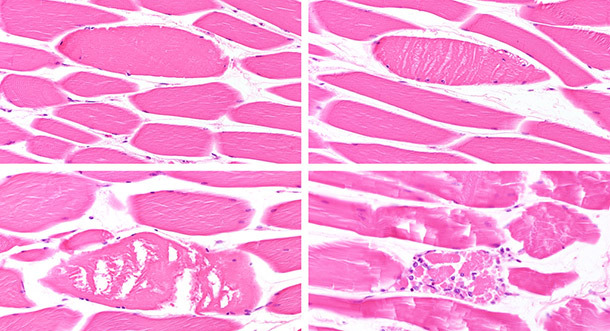 Different stages of myofiber degeneration necrosis