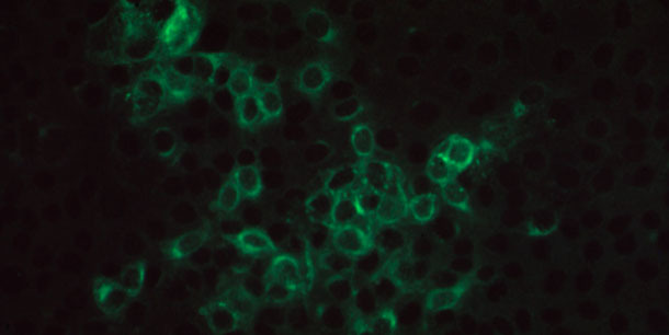 Photomicroscopy of positive immunofluorescence on PRRSV-infected MARC145 monolayer incubated with a pig serum containing PRRSV specific IgG antibody and stained with goat anti-porcine IgG antibody conjugated with FITC