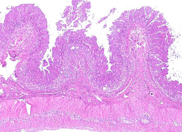 Ileum. Marked lymphocyte depletion and granulomatous inflammation of the Peyer’s patches at the ileum of a pig affected by PCV2-systemic disease. Hematoxylin and eosin stain.