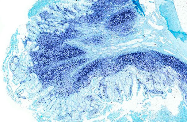 Ileum. The same ileum of the PCV2-systemi disease affected pig displays a massive amount of PCV2 genome at the Peyer’s patches and the intestinal mucosa. In situ hybridization to detect PCV2; fast green counterstain.